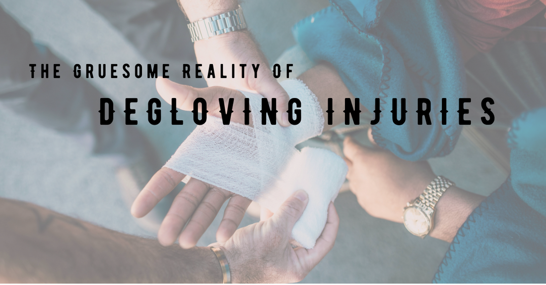 The Gruesome Reality Of Degloving Injuries