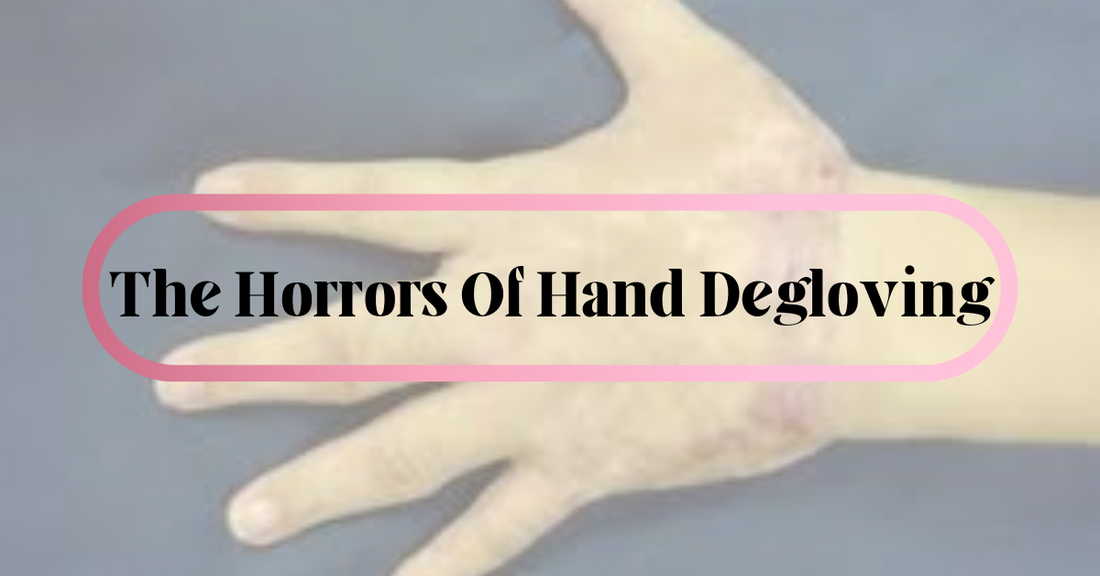 The Horrors Of Hand Degloving